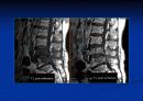 척추질환에 따른 영상의학 영상 32페이지