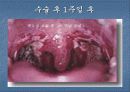 편도선 절제술 25페이지