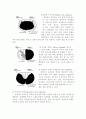 척수 손상(spinal cord injury) 5페이지