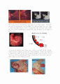 [논문] 위암(gastric cancer) 3페이지