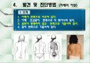 척추측만증 파워포인트 6페이지