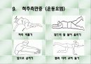 척추측만증 파워포인트 18페이지