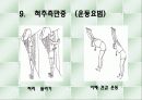 척추측만증 파워포인트 21페이지