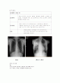 폐결핵 케이스 15페이지