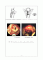 Croup 증후군 7페이지