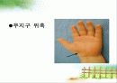 수근관증후군에 관한 자료입니다. 13페이지