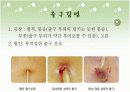 복막투석 환자의 도관관리 15페이지