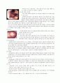 간경화 (Liver cirrhosis) 3페이지