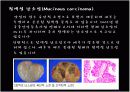Ovariancancer 난소암 17페이지