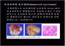 Ovariancancer 난소암 18페이지