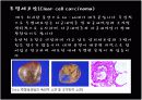 Ovariancancer 난소암 19페이지