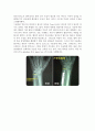 TFCC injury(삼각 섬유 연골 복합체 손상) 3페이지