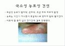 자가 면역 질환 건선 23페이지