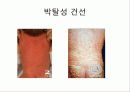 자가 면역 질환 건선 26페이지