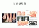 자가 면역 질환 건선 30페이지