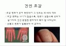 자가 면역 질환 건선 31페이지