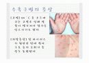 수족구병(Hand Foot Mouth disease) 4페이지