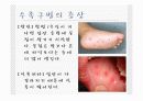 수족구병(Hand Foot Mouth disease) 5페이지