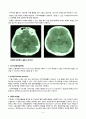 지주막하 출혈 - Sub Arachnoidal Hemorrhage (SAH) 4페이지