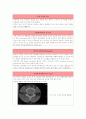 요추추간판탈출증 4페이지