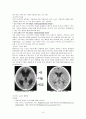 수술실실습 레포트 뇌수종(Hydrocephalus) 7페이지