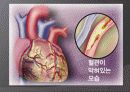 심근경색 er 컨퍼런스 문헌고찰 ppt ♥ 4페이지