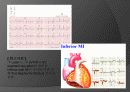 심근경색 er 컨퍼런스 문헌고찰 ppt ♥ 32페이지
