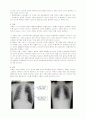 기흉(pneumothorax) 2페이지