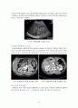 수술실 case study (Laparoscopic Parcial Nephrectomy) 10페이지