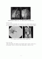 수술실 case study (Laparoscopic Parcial Nephrectomy) 11페이지