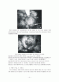 수술실 case study (Laparoscopic Parcial Nephrectomy) 15페이지