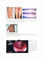 베체트병의 원인 및 증상, 치료방법 6페이지