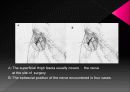 Anatomicl  Variability of the Laterl  Femoral  Cutneous  Nerve : Findings From a Surgical Series 10페이지