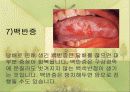흡연이 구강건강에 미치는 영향 9페이지
