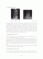 [간호학]척추탈위증spondylolisthesis 2페이지