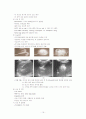 간세포암(HCC, hepatocellular carcinoma) 16페이지
