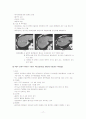 간세포암(HCC, hepatocellular carcinoma) 17페이지