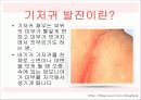 기저귀발진 3페이지