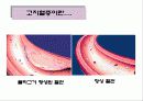 고지혈증에 대한 내용 6페이지