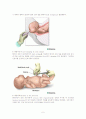 제왕절개(Cesarean Delivery)환자의 수술 전. 후간호 5페이지
