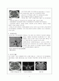 수술실 - 뇌동맥류(Cerebral Aneurysm) 6페이지