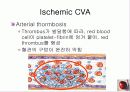 정의,위험요소,유형,자연경과,합병증 10페이지
