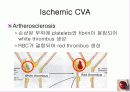 정의,위험요소,유형,자연경과,합병증 12페이지