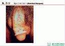HSV 제출 - Herpes simplex virus 1,2 associated skin disorder 10페이지