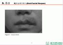 HSV 제출 - Herpes simplex virus 1,2 associated skin disorder 13페이지