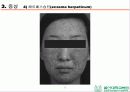 HSV 제출 - Herpes simplex virus 1,2 associated skin disorder 17페이지