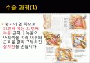 Simple Nephrotectomy 6페이지