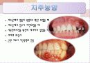 치주학 PPT자료 (3장요약) - 복사본 13페이지