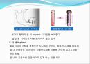 임플란트(Implant)와 관교의치의 개념 및 용어정리.ppt 6페이지