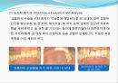 임플란트(Implant)와 관교의치의 개념 및 용어정리.ppt 12페이지
